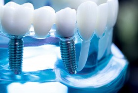 Dental implants in a clear plastic display stand