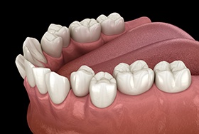 Illustration of crowded teeth