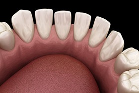 Illustration of teeth with gaps