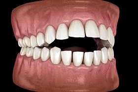Illustration of teeth with open bite