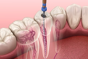 Illustration of a root canal
