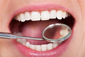 Close up of a dental mirror and a patient’s teeth