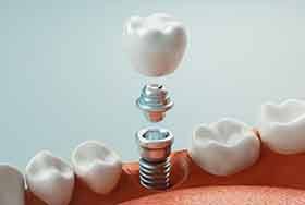 a 3D render of dental implant parts