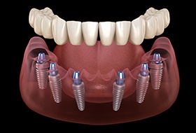 Illustration of dental implants