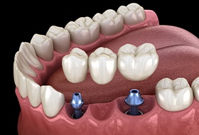 Animation of implant fixed bridge placement