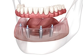 Illustration of implant dentures in a lower arch with a white background