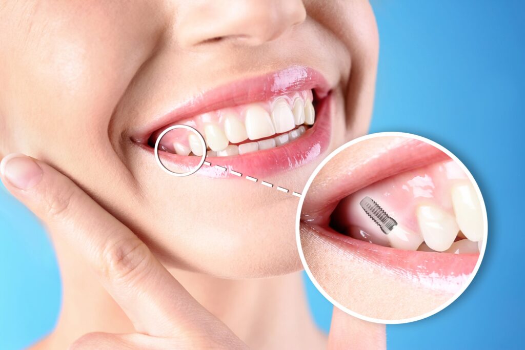 Nose-to-chin view of a woman smiling with one tooth indicated as an implant