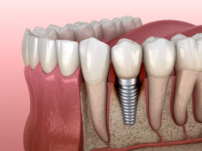 an infected dental implant